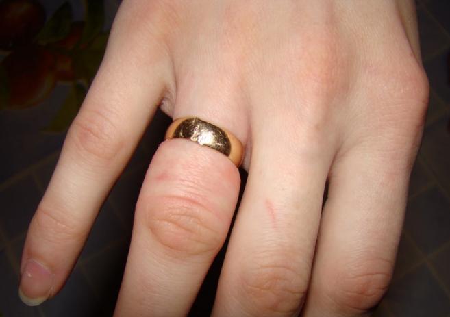 Какие бывают способы снять кольцо с опухшего пальца?