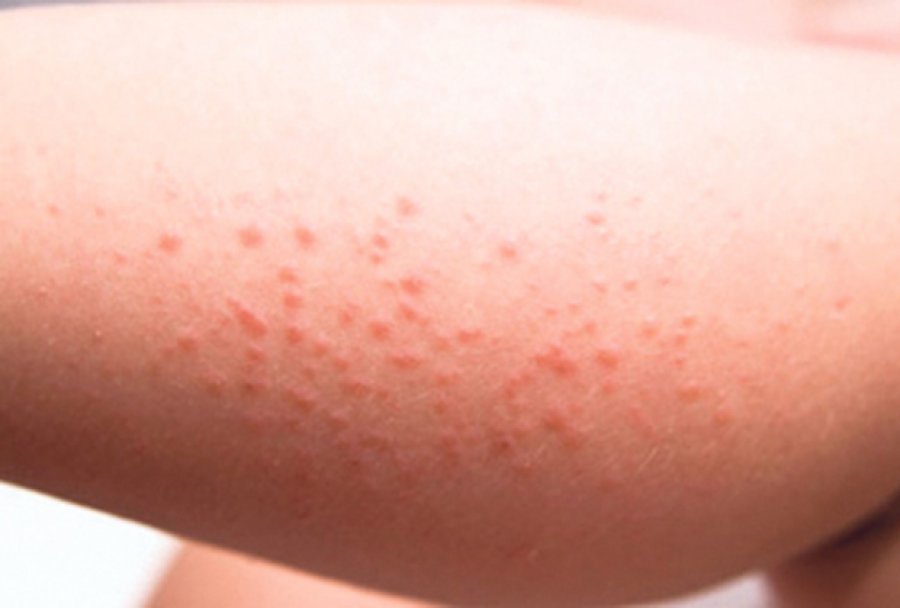 Какие бывают кожные заболевания?